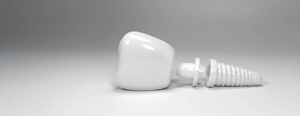 Impianti dentali metal-free cosa significa e per chi sono indicati