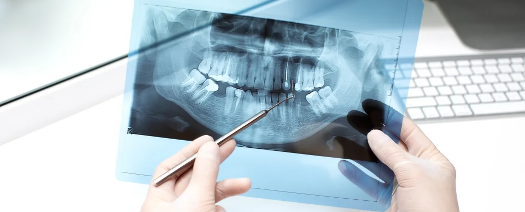 zirconia o titanio come scegliere impianto giusto